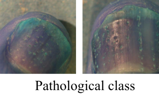 Microscopic Nail Disease Dataset