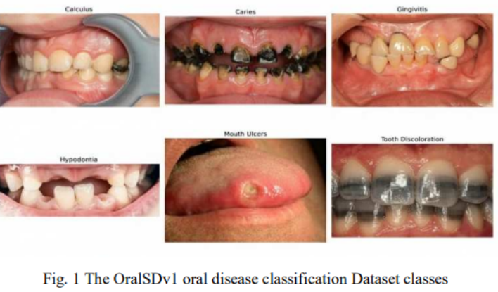 OralSDv1